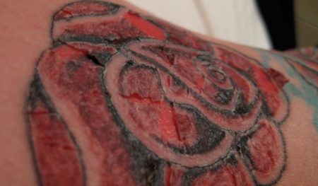 Tattoo Ink Poisoning